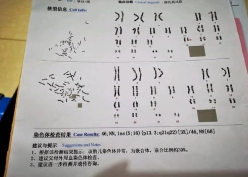 哪些人需要做染色体检查？我们为什么要做染色体筛查？插图