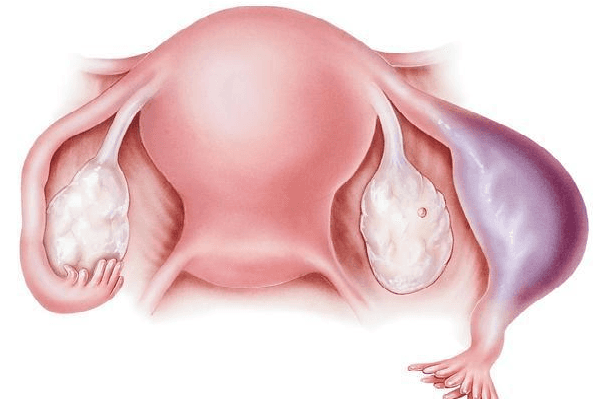 多囊的不成熟卵泡会萎缩吗？多囊卵巢综合症影响因素有哪些？有多囊卵巢综合症可以做试管婴儿吗？插图(1)